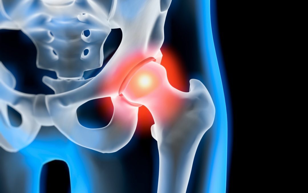 Artrosi e protesi dell’anca e del ginocchio