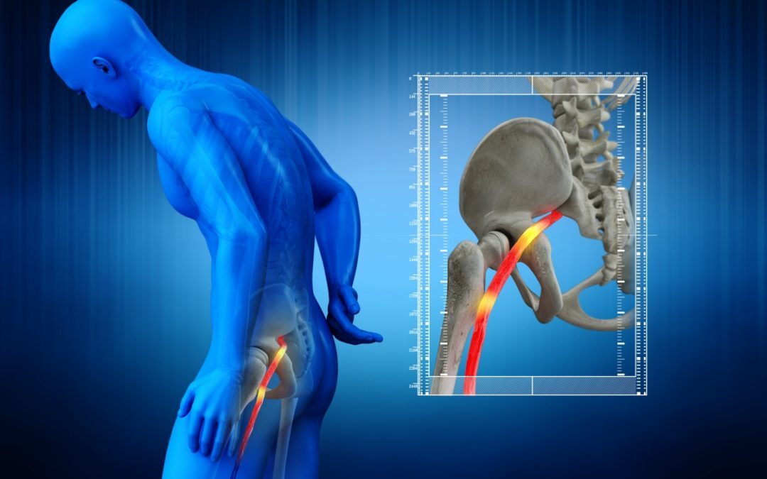 Sindrome del piriforme o falsa sciatica