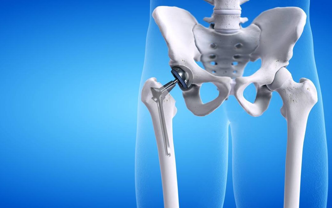 Protesi d’anca: campanelli d’allarme