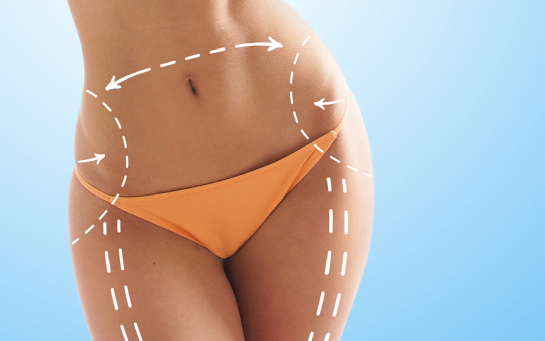 Ossigeno Ozono Terapia in mesoterapia per cellulite