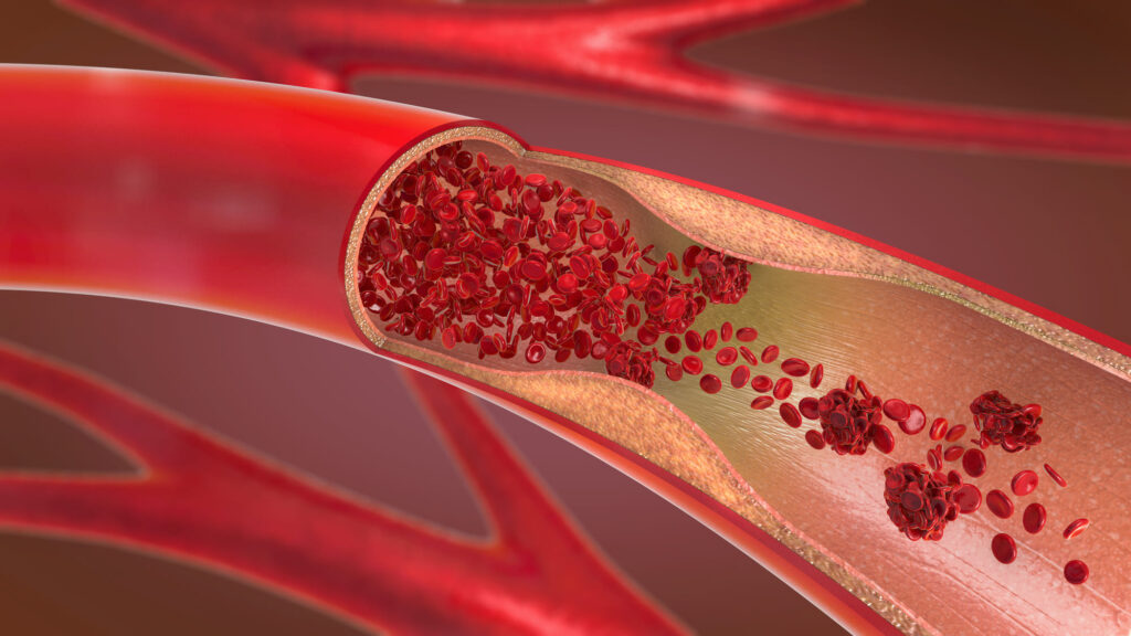 restringimento arterie