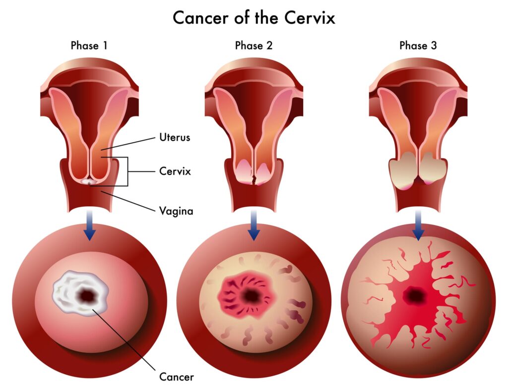 tumore cervice uterina