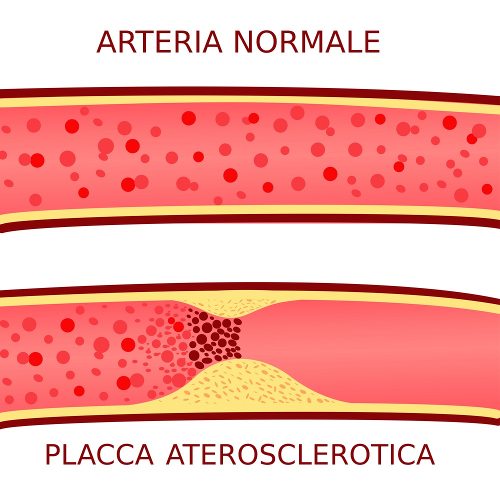 placca aterosclerotica