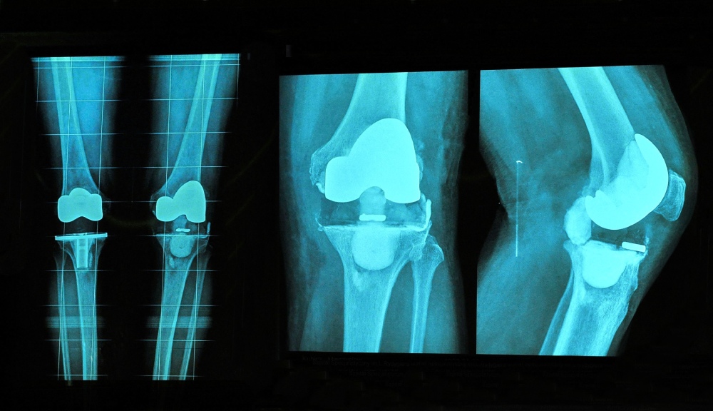 rappresentazione di una protesi al ginocchio