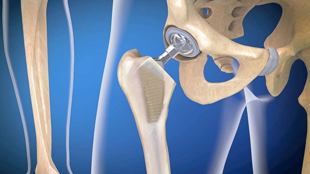 rappresentazione di una protesi all'anca