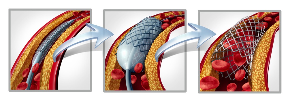 Stent coronarico e angioplastica, inserito in un'arteria che viene aperto per aumentare il flusso sanguigno.