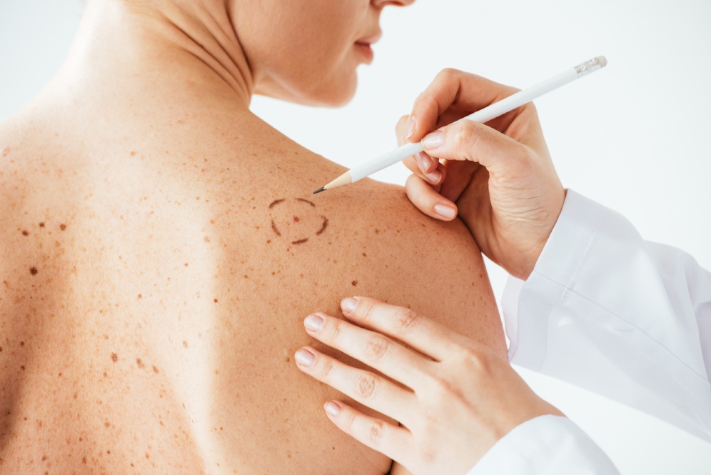 Attenzione al melanoma: ecco come proteggere la pelle