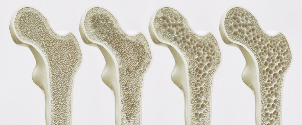 Osteoporosi degenerazione di ossa e articolazioni