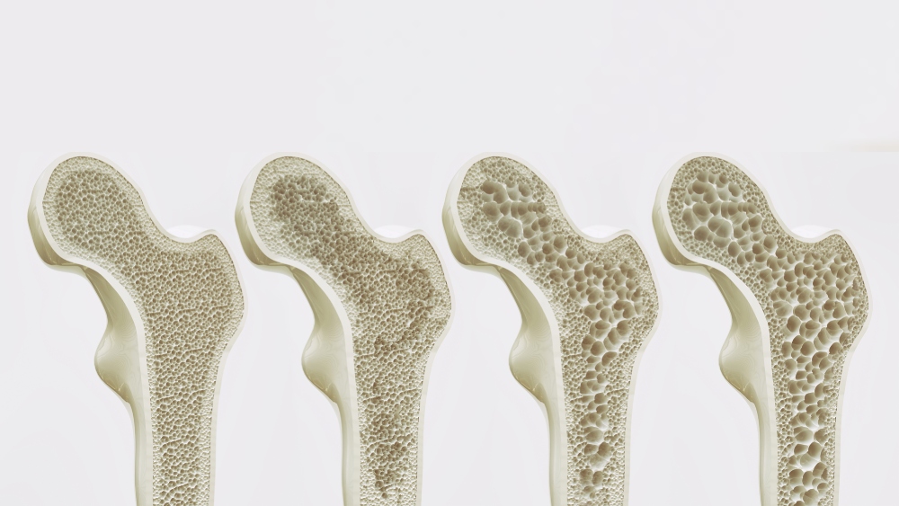 Effetto dell'osteoporosi sulle ossa