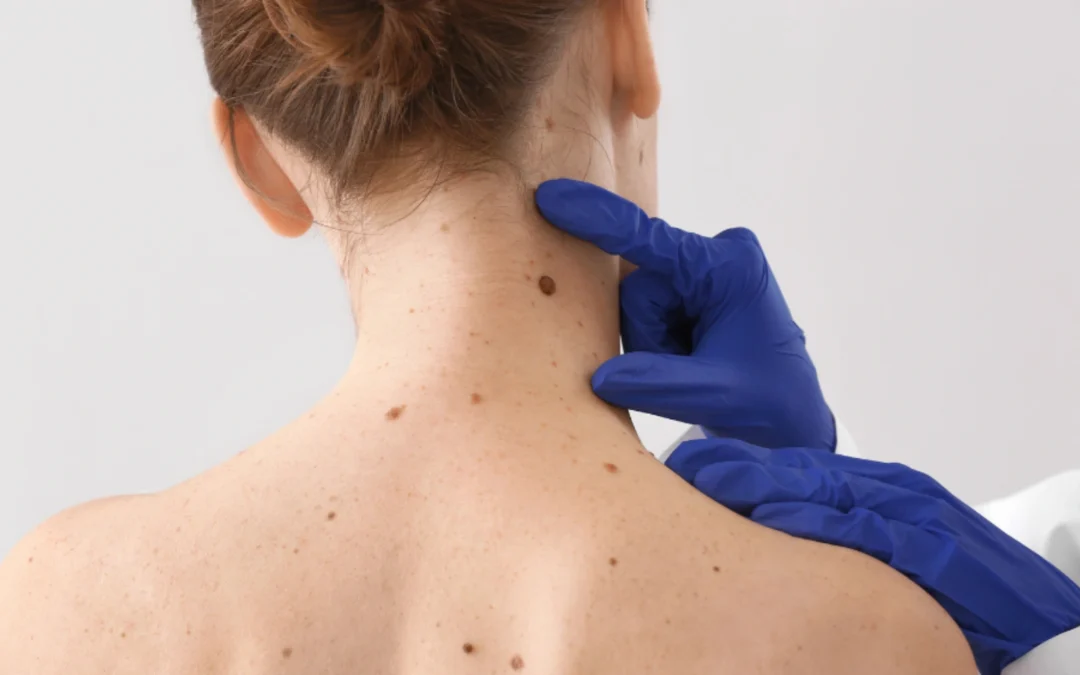 Prevenzione del melanoma: la diagnosi precoce fa la differenza 