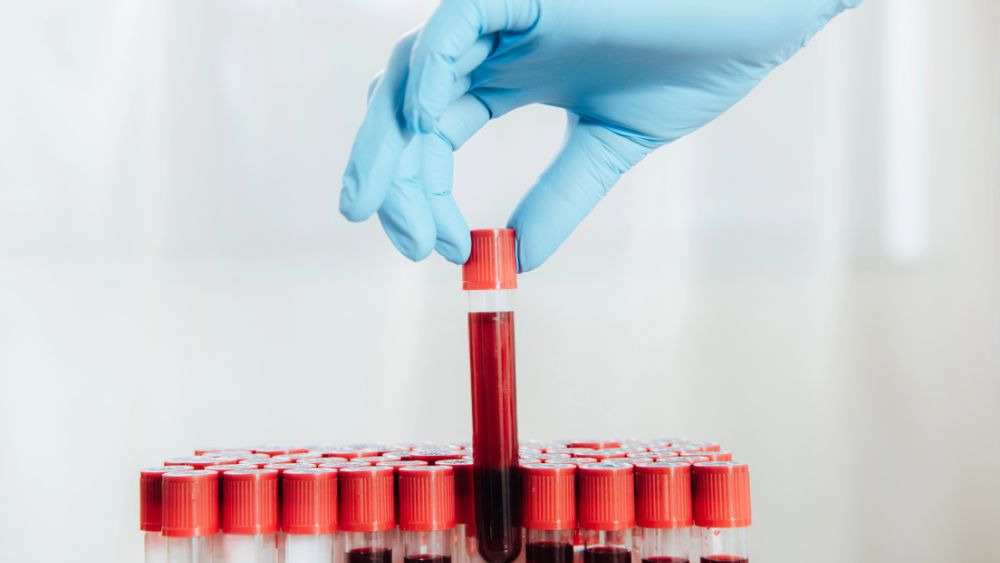 Provette per i test di laboratorio - Tempo di tromboplastina parziale attivato aPTT 