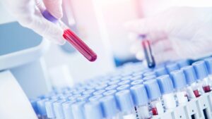 Test dell’emoglobina A1c un indicatore chiave della salute glicemica