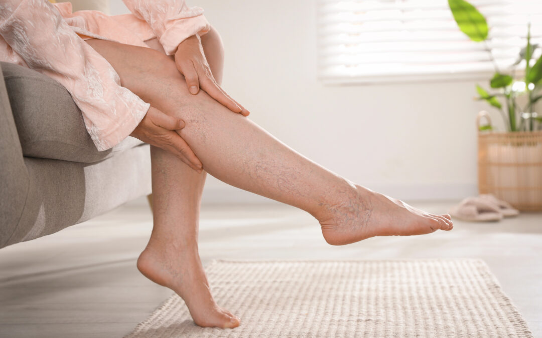 Varici ed emorroidi: niente più chirurgia