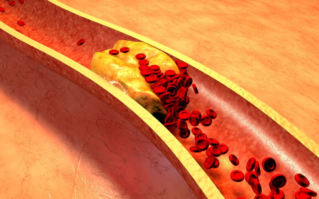 Colesterolo alto: quali valori sono significativi di rischio